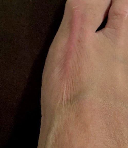 Mary's Foot Scar